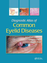 Image of Diagnostic Atlas of Common Eyelid Diseases